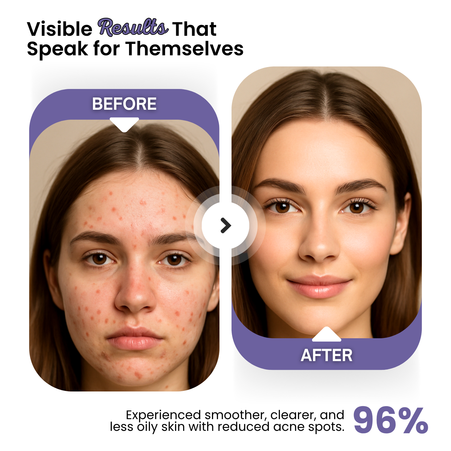 Acne-Prone Face Moisturizer: Clearer Skin and Balanced Hydration - Image 3